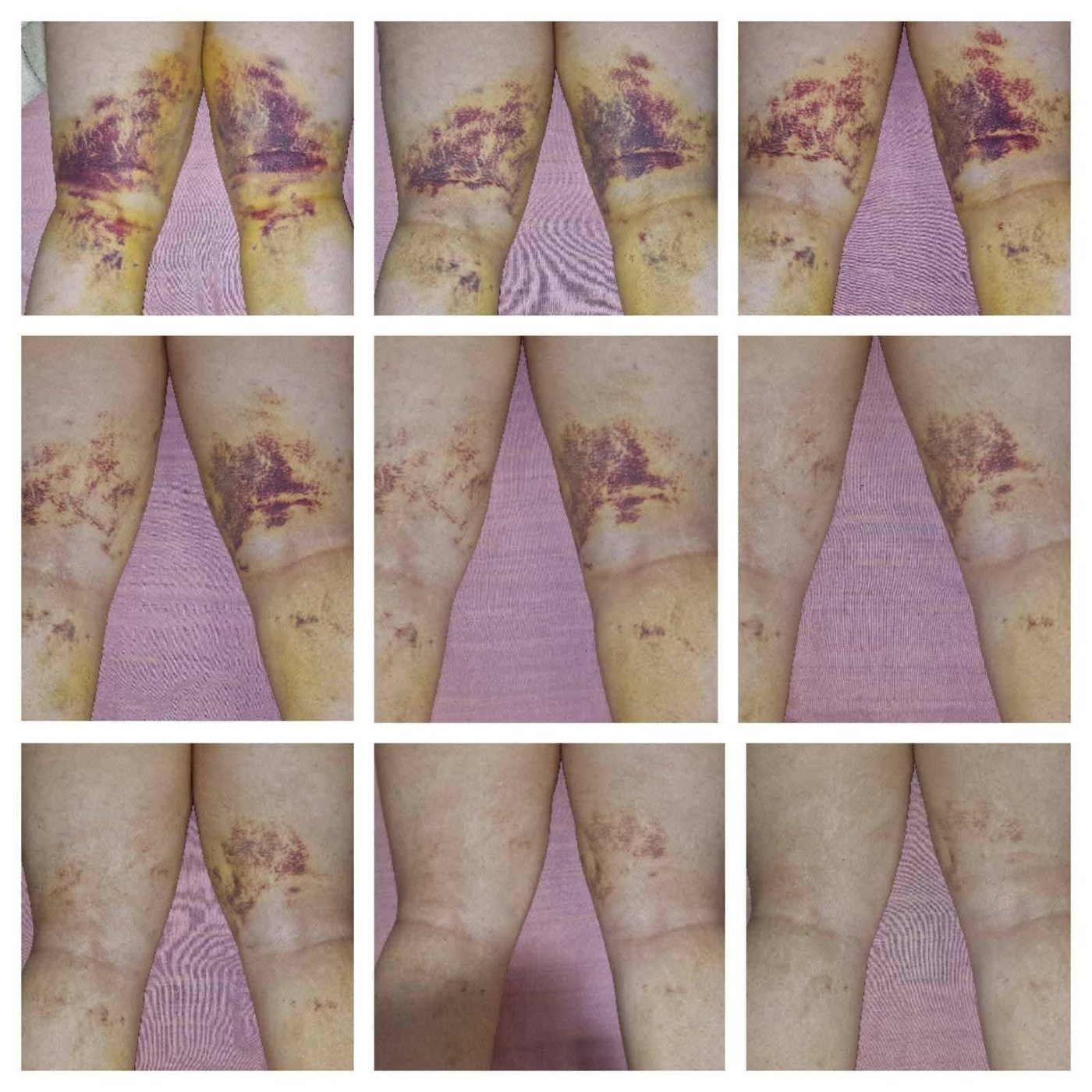 Liposukcija lipedema — oporavak uz MLD